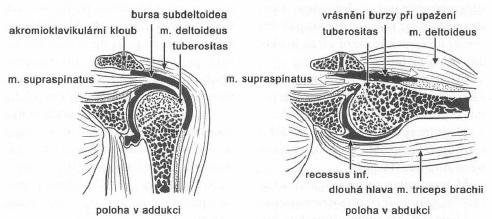 muskuloskeletních syndromů ramene spolu s netraumatickou instabilitou ramene a přetížením lopatkových svalů.