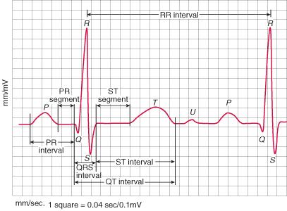 4.3 Podrobný popis EKG křivky z pohledu fyziologie srdce Na křivce EKG rozpoznáváme zaoblené výchylky s nízkou amplitudou, které nazýváme vlny. Jedna perioda EKG křivky obsahuje dvě vlny P a T.