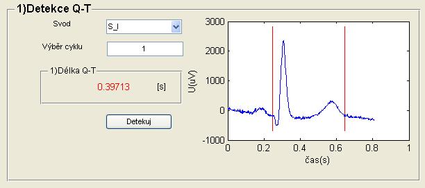 Stisknutím tlačítka Detekuj dojde k detekci začátku kmitu Q a konce vlny T na vybraném cyklu a svodu. Následně dojde i k výpočtu délky Q-T.