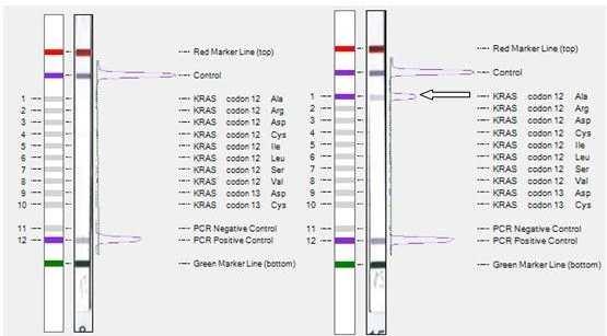 Modifikace PCR Multiplex PCR obsahuje několik sad primerů v jedné reakci např. pro detekci všech nejčastějších mutací daného genu Př.: ViennaLab StripAssay Princip: 1.