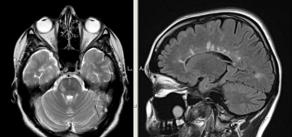 Kazuistika Diagnostika onemocnění MR mozku v roce 2016 Vlevo T 2 vážená sekvence, vpravo