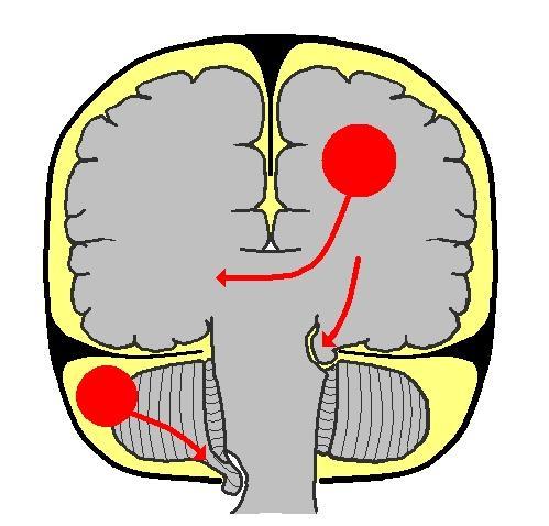 Tlakové konusy 1. Subfalciální (laterální) konus -při jednostranném expanzivním procesu v hemisféře obvykle bez ložiskových příznaků vyvolaných přímo kuželem 2.