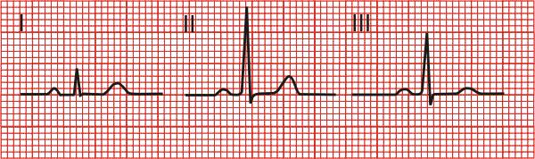 Principy EKG 12