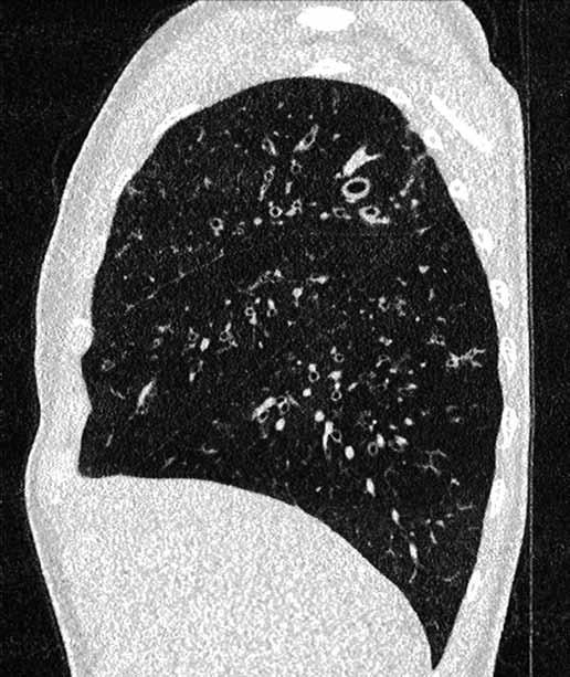 msv); axiální (A) a sagitální (B) obrazy šíře 0,75 mm vlevo inspirium, vpravo exspirium) Fig. 1.