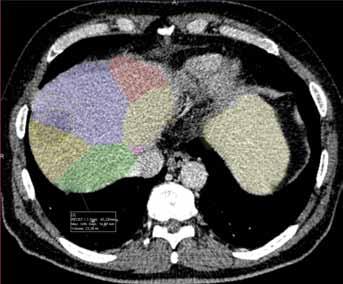 A CT; B 3D CT angiograpyh showed doubled arterial supply of the liver metastatic lesion; C color coded liver segmental anatomy projected into CT image, metastasis between 8 th and 4 th segment; D
