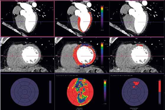 Obr. 5A Obr. 5B Obr. 5. CT angiografie koronárních tepen s recidivou bolestí na hrudi u nemocného po stentáži ramus intervenricularis anterior.