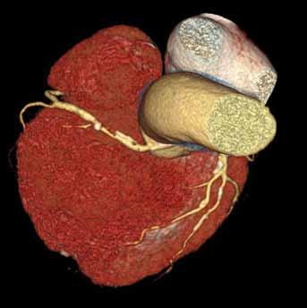 Fig. 6. Evaluation of the fraction flow reserve, based on coronary CT angiography analysis, experimental SW of siemens Healthineers (tested by the authors).