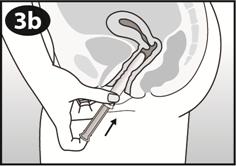 Jemně zaveďte trubičku do pochvy, dokud se Vaše prsty (na části určené k uchopení) nebudou dotýkat Vašeho těla. Pak ukazováčkem jemně zatlačte píst přímo do trubičky.