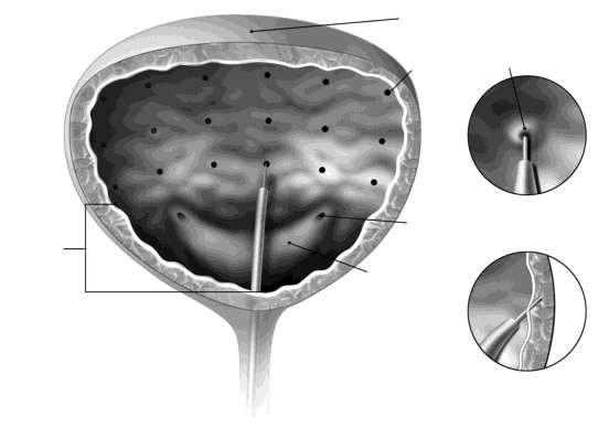 Jehla se zavádí přibližně 2 mm do detruzoru a 20 injekcí, každá o objemu 0,5 ml (celkový objem 10 ml) se aplikuje přibližně ve vzdálenosti 1 cm od sebe (viz nákres níže).