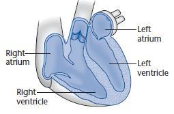 Poruchy svalů srdce Lidské srdce síně a komory komory jsou ze silné svaloviny, zejména levá komora Dilatační kardiomyopatie (DCM) - nemoc srdečního svalu (myokardu) - zvětšení komor, zúžení stěn,
