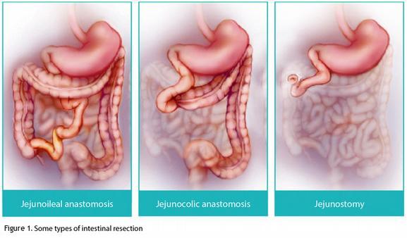 Klasifkace SBS podle anatomie typ I enterostomie 115 cm typ II jejunokolická