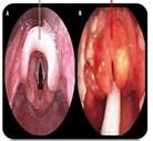 Diferenciální diagnostika epiglotitidy a laryngitidy Epiglotitis Etiologie bakteriální,