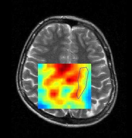 4.3 Zdraví dobrovolníci 54 (a) Vybraná oblast na MRI (b) Vybraná oblast na DWI (c) Korelace Obrázek 24: Příklad závislosti koncentrace cholinu [Cho] na stopě difuzního tenzoru T r ADC ve vybrané