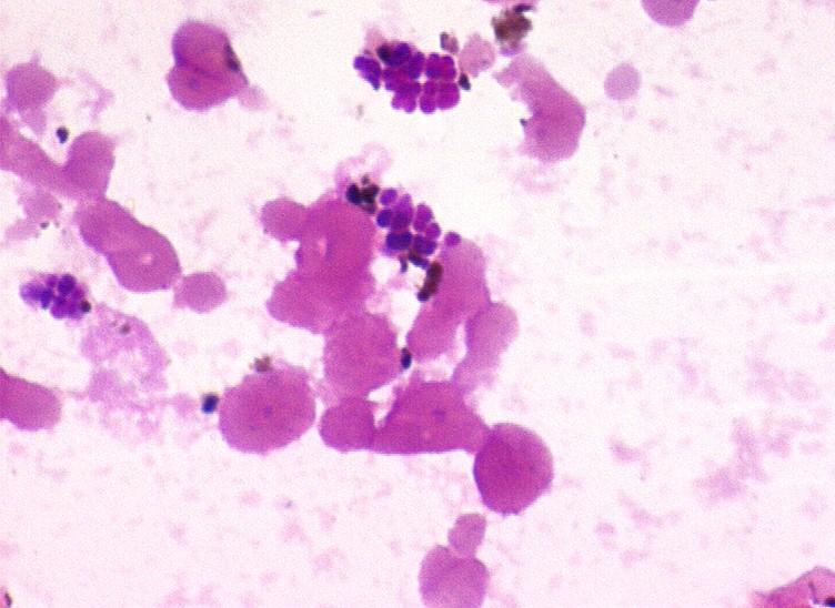 Infekce spojené s používáním cévních katétrů Staphylococcus aureus vysoká virulence, typický je závažný průběh často sepse nebo těžká sepse, horší prognosa (MSSA - MRSA) vysoké riziko metastatických,