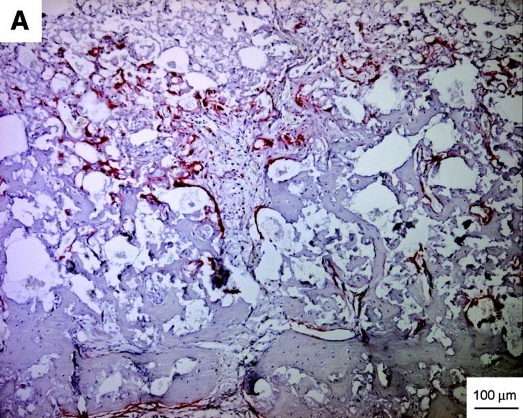 Kost Využití: osteogenesis imprerfecta (mutace v genu pro kolagen typu I), osteoporoza (řídnutí kostí) Scaffold: mechanická pevnost, ideální velikost pórů,