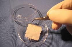Severe burns Diabetic skin ulcers INTEGRA -