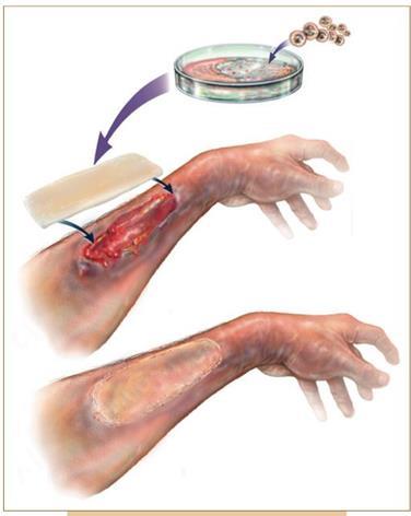 healing using the patient s own cells.