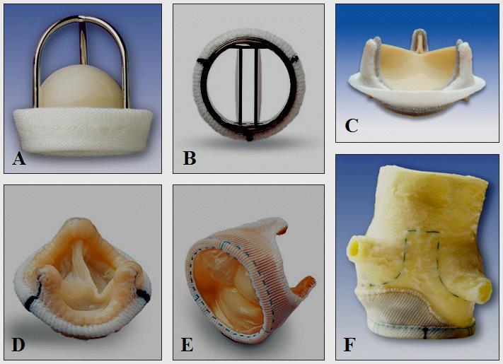 Artificial Heart Valves Mechanical (A, B) Caged Ball Hinged Leaflets Stented Bovine Pericardium Biological (C-F) Glutaraldehyde-fixed Animal Tissues Stentless Porcine Valve Stented Porcine Valve