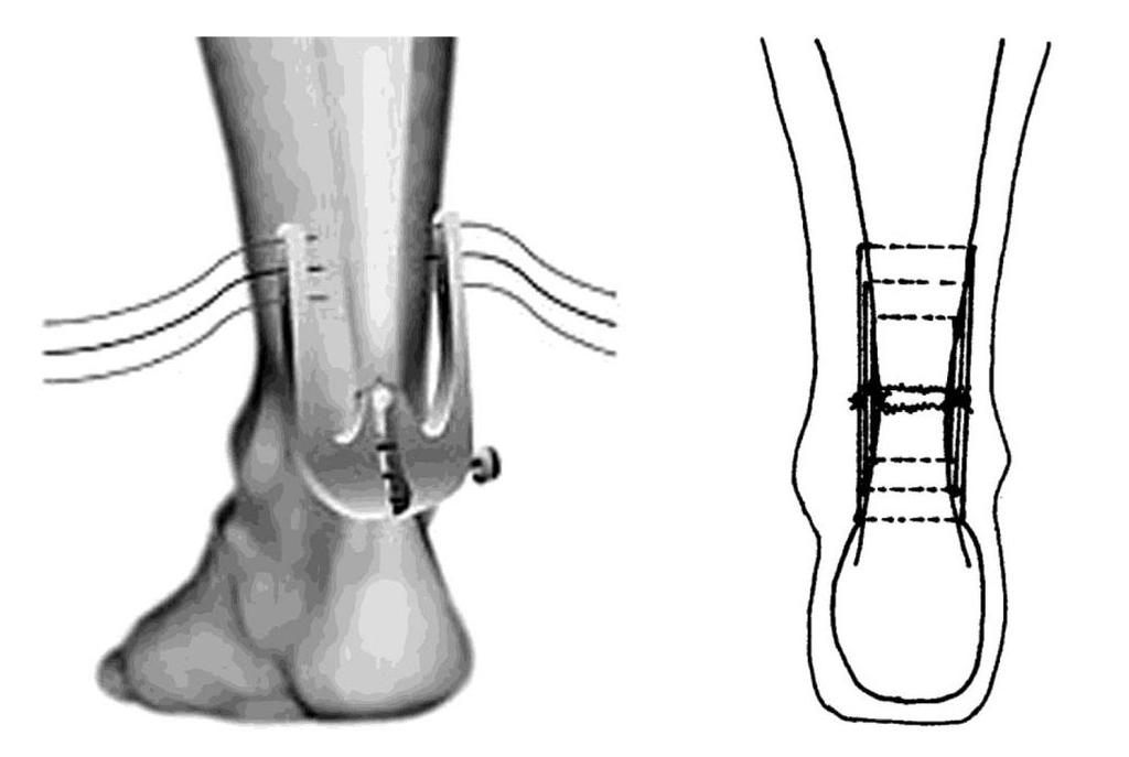 Obrázek 10. Sutura technikou Achillon System (Filan, 2013). Při různých defektech Achillovy šlachy nebo u zastaralých ruptur může dojít k insuficienci m. triceps surae z prodloužení šlachy.
