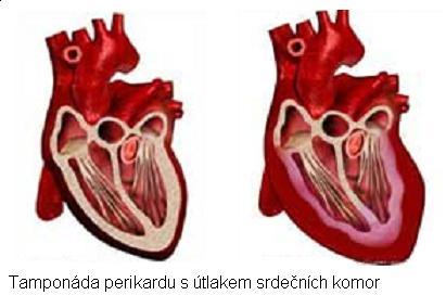 Hemodynamický model obstrukčního šoku ABP CVP