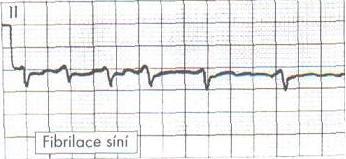 hypomagnezenémií, hypotermií, acidózou nebo přímým mechanickým drážděním. Vždy pátráme po vyvolávající příčině a neprodleně se jí snažíme odstranit.