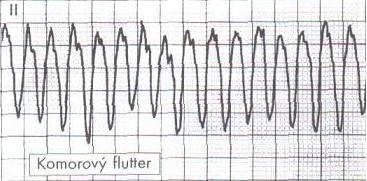 6. Asystolie a PEA Asystolie a elektromechanické disociace (PEA) je je součástí algorytmu CRP guidelines. V těchto případech se zahajuje kardiopulmonální resuscitace. 7.