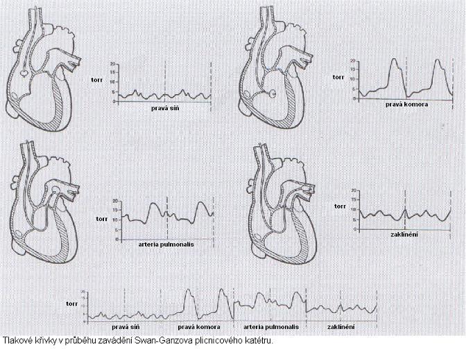 Zprvu sledujeme na tlakové křivce monitoru CVP (1-10mmHg), při zavedení katetru na 20cm naplňujeme balónek předepsaným objemem vzduchu (1,5 ccm), ten je dále unášen krví ve směru krevního proudu.