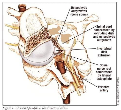 Faktory patogeneze spondylogenní myelopatie spondylóza vrozená šíře páteřního kanálu cévní zásobení