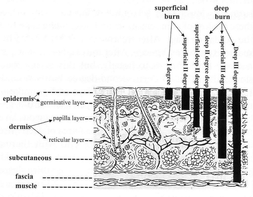 Příloha č. 5 Stavba kůže s ilustrací hloubky popálení (Xu, 2004, s.