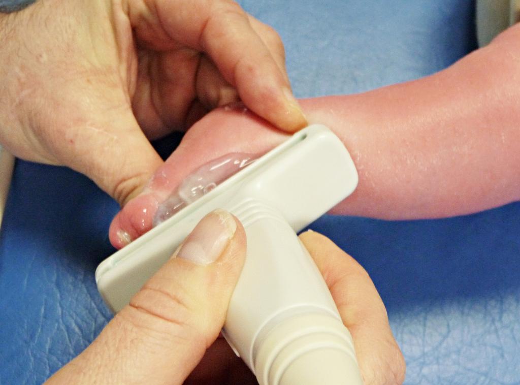 range from 0 up to 6 and Pirani score of 6 represented clinically the most severe form of clubfoot abnormality.