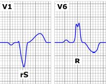 1.4 Blokáda levého Tawarova raménka Při blokádě levého Tawarova raménka (LBBB) je narušené vedení přes levé Tawarovo raménko, proto se levá komora aktivuje později, až po přímém prostupu
