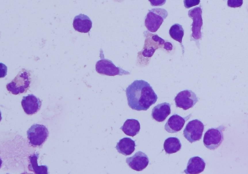 566/ul, ery 8/ul, CB 4,8 g/l, glu 1,09 mmol/l, lakt 4,5mmol/l, KEB -36 Cytologický nález 1. čtení: Nález lymfocytární pleocytozy s plazmocytární reakcí a příměsí PMN- tedy na 1.