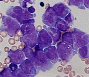 None of the morphological parameters sharply discerns neoplastic cells (Perske et al.