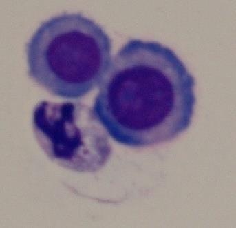 11/ ul, ery 0, CB 1,3 g/l, glu 1,48, lakt 8,85, KEB -69 Cytologický nález 1.