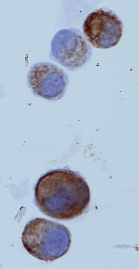 Kazuistika blíže neurčené (?) nádorové buňky.