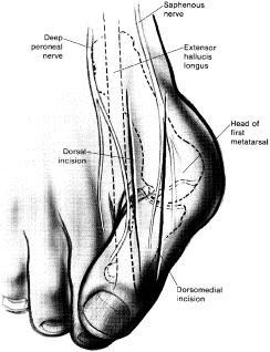 1.4.2. Patogeneze Při deformitě HV se uchyluje první nártní kost ven a články prstů dovnitř. Osa palce je tak porušena a vzniká vbočení neboli valgozita (Kubát, 1985).