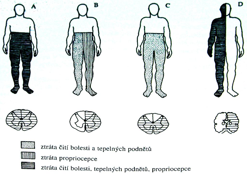 Příklady míšních postižení A. transversální míšní léze B.