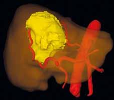 Jaterní nádory Nejdůležitější moment v hodnocení typu jaterní léze spočívá v odlišení maligní a benigní etiologie.