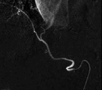 Nutné je zmínit také pseudotumory, do kterých se řadí zánětlivá ložiska (např. abscesy, granulomatózní rozsev) a ischemické léze. V diferenciální diagnostice zpravidla nečiní obtíže odlišení tzv.