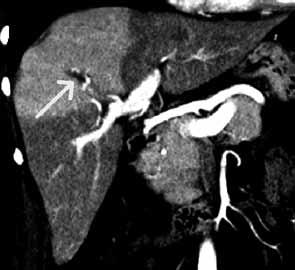 A the right liver lobe is hyperdense after right portal vein embolization (PVE); B hyperdense the 8 th segment of the liver after segmental portal vein thrombosis; C The reconstruction of the 8 th