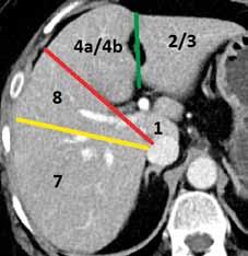 Schematic Couinaud classification of hepatic segments in CT imaging Skutečný rozsah jaterních segmentů se může značně lišit od velikosti, tvaru a někdy i počtu segmentů vytvořených podle