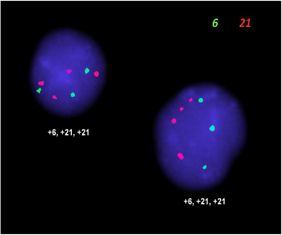 Obrázek 9 Hyperdiploidní jádra detekovaná metodou I-FISH CEPX/CEP 18 A +X +X B A) Vyšetření I-FISH centromerickými sondami pro chromosomy X a 18 u dívky.