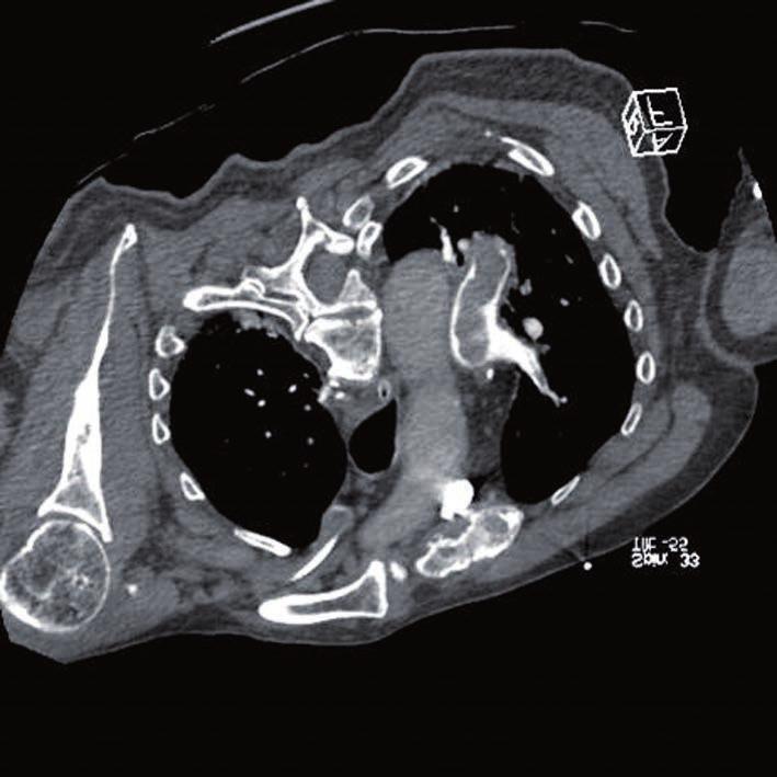 RECIDIVA AKUTNÍ VYSOCE RIZIKOVÉ PLICNÍ EMBOLIE U PACIENTA S PRAVDĚPODOBNOU Obr. 2: CT angiografie plicnice centrální lokalizace embolizace do plicnice byla bez známek event.