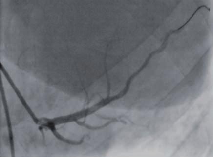 Interní klinika kardiologie a angiologie, 1. LF UK a VFN, Praha studií byli vždy vyloučeni nemocní se symptomatickou ischemickou chorobou srdeční.