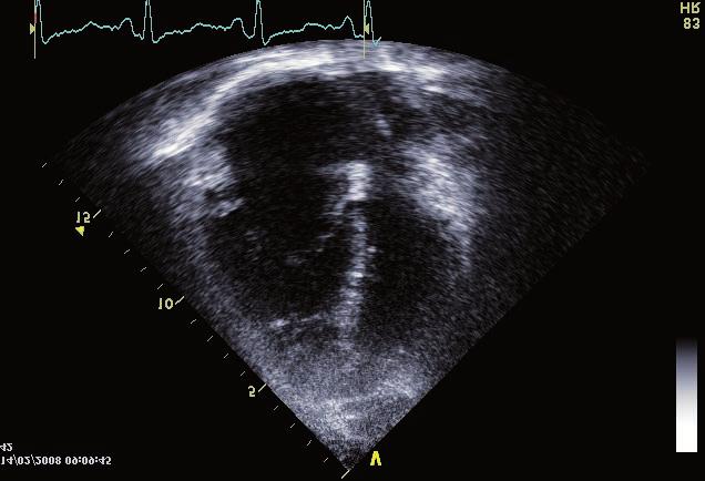 If CTEPH is highly suspected based on these tests, additional complex examination including CT angiography of pulmonary artery, conventional angiography of pulmonary artery and right heart