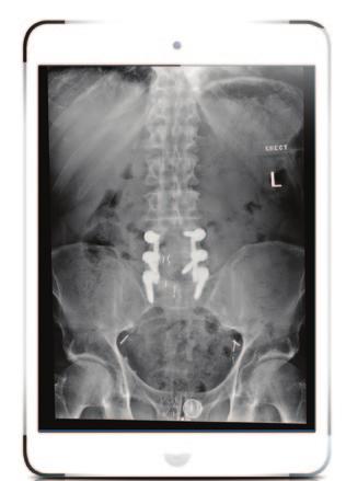 WHY SHOULD YOU COMPROMISE SAGITTAL BALANCE?