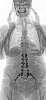deformities (scoliosis, kyphosis, ),
