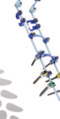 Alpine XC Adjustable MIS Fusion System