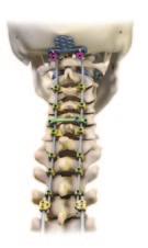 75 Deformity System PathFinder NXT