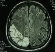 Mitochondriální encefalomyopatie s mléčnou acidosou a epizodami podobnými mrtvici / Mitochondrial encephalomyopathy with lactic acidosis and stroke-like episodes (MELAS) - nejčastější mitochondriální
